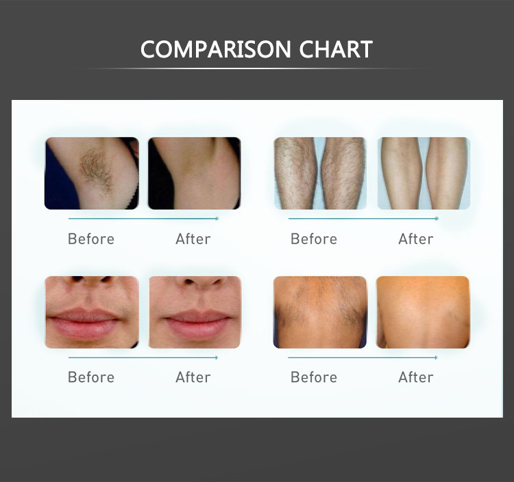 diode laser hair removal machine